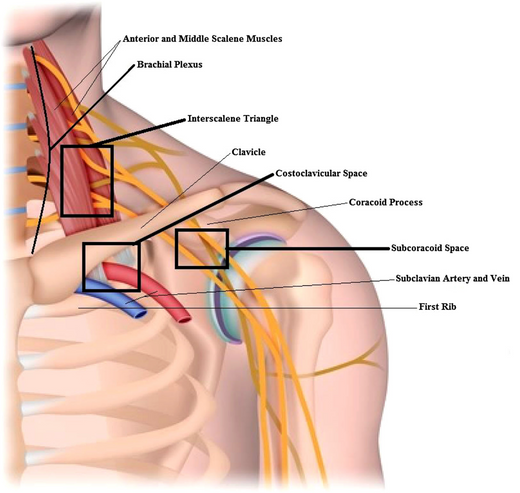 Thoracic Outlet Syndrome - A Diagnostic Challenge